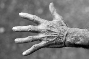 TRATAMIENTO DEL SÍNDROME DE LA MANO INTR